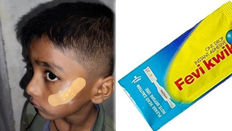 கர்நாடகாவில் ஃபெவிக்விக் பயன்படுத்தியதற்காக செவிலியர் இடைநீக்கம் செய்யப்பட்டார்!